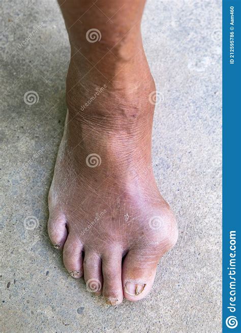 Gout Inflammation On Big Toe Joint And Fungal Nail Infection Stock