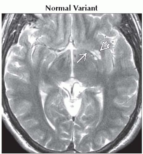 Enlarged Perivascular Spaces Neupsy Key