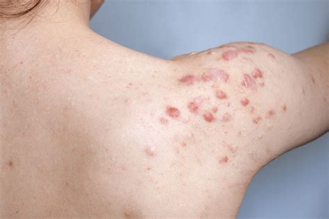 Shoulder Acne Causes Treatments Similar Conditions And More