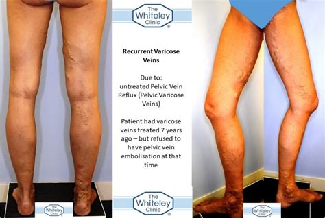 Recurrent Varicose Veins Due To Untreated Pelvic Veins The Whiteley Clinic