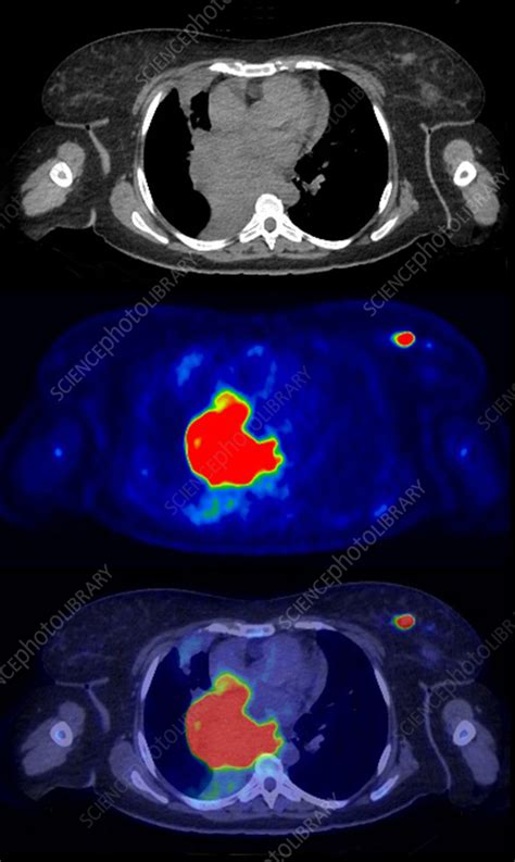 Diffuse Large Cell B Cell Lymphoma Ct And Pet Scans Stock Image