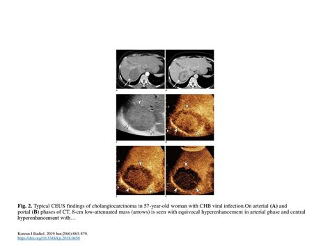 Fig 2 Typical Ceus Findings Of Cholangiocarcinoma In 57 Year Old