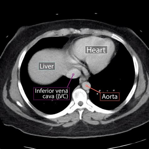 Gross Anatomy Glossary Axial Abdominal Ct Draw It To Know It