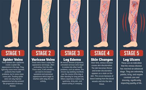 Essential Oils For Varicose Veins What Are Your Options