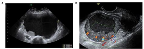 Ovarian Cyst And Cancer Ultrasound