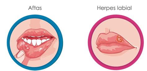 ¿cómo Reconocer Si Tengo Herpes Labial O Un Afta Bucal