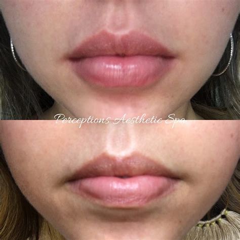 A Natural Pout Is Possible With Lip Fillers💉👄 These Lips Were Done By