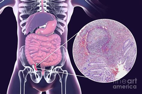 Chronic Appendicitis Photograph By Kateryna Kon Science Photo Library