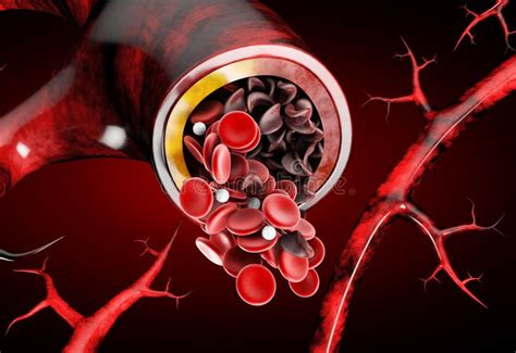 Anemia De La Célula Falciforme Mostrando El Vaso Sanguíneo Con El