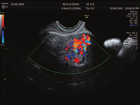 Transvaginal Doppler Ultrasound Of The Uterus Shows Enlarged High Images