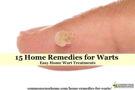 15 Home Remedies For Warts Easy Home Wart Treatments Kitchen