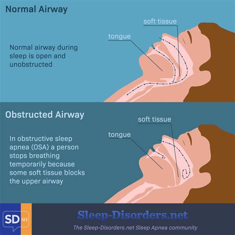 What Are The Intraoral And Dental Manifestations And Signs Of Sleep Apnea Write