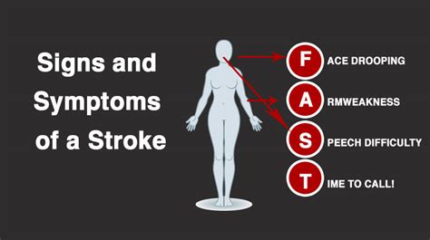 Signs And Symptoms Of A Stroke Everyone Should Know About Womenworking