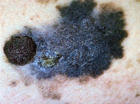 Is It Skin Cancer 38 Photos That Could Save Your Life Pictures Cbs