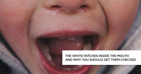 Leukoplakia Patches Causes Symptoms And Treatments