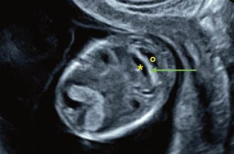 Dépistage Du Spina Bifida Au Premier Trimestre Revue Vision