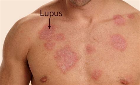 Lupus Symptoms 13 Ways To Spot Lupus Disease Early