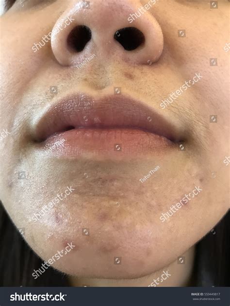 Multiple Acne Scar Around Lips Fat Stock Photo 559449817 Shutterstock