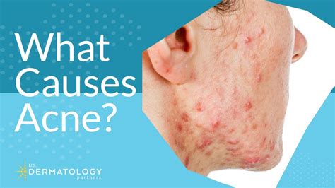 What Causes Acne Explained By Dermatologist Youtube
