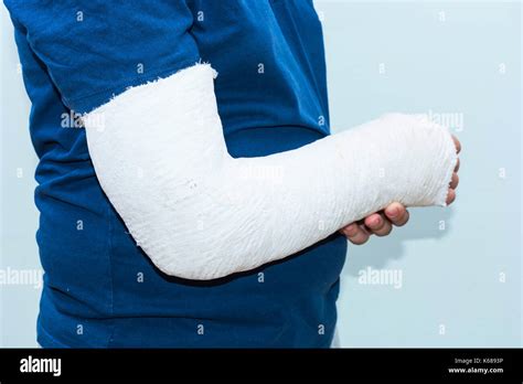 Fractured Elbow Hi Res Stock Photography And Images Alamy