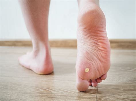 Can You Live With Foot Warts Cincinnati Foot And Ankle Care