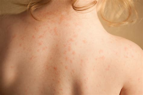 Heat Rash Treatment Rash Under The Breast Causes And When To See A