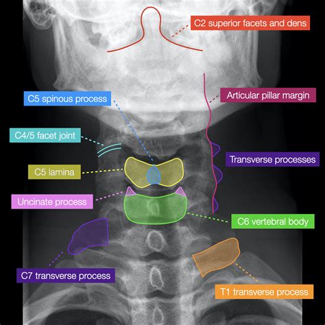 Normal Cervical Spine Radiographs Image