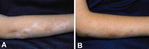 topical calcipotriene for morphea linear scleroderma journal of the american academy of