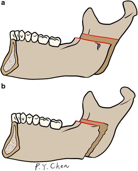 Evolution Of The Mandibular Sagittal Split Osteotomy A The Sagittal