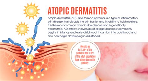 Atopic Dermatitis Eczema Infographic Interesting Facts 2019