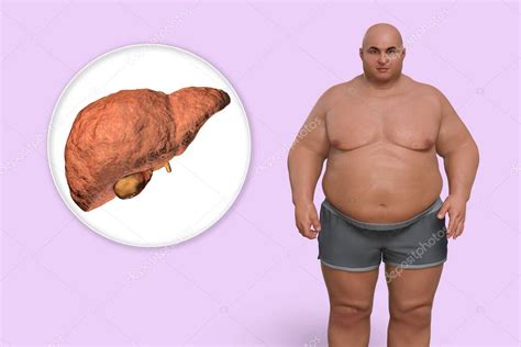 Fibrotic Liver In Obese Man 3d Illustration Concept Of Obesity And Inner Organs Diseases