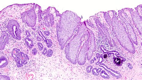 Pathology Outlines Squamous Metaplasia