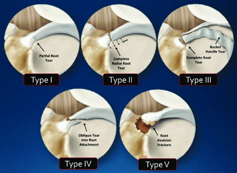 Classification Of Meniscal Root Tears According To Laprade 2014 Type