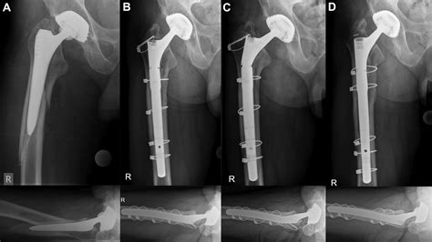Modified Extended Trochanteric Osteotomy For The Treatment Of Vancouver