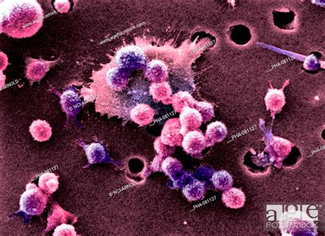 Scanning Electron Micrograph Sem Of Malignant B Cell Lymphocytes Seen