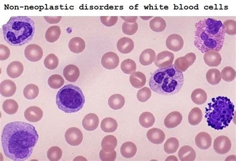 Non Neoplastic Disorders Of White Blood Cells