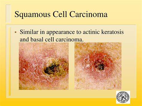 Ppt Skin Cancer Prevention And Identification Powerpoint Presentation