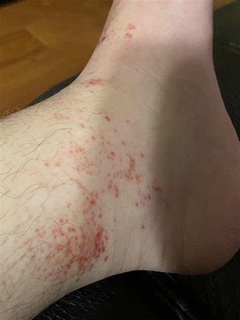 Finally Got Cast Off After 8 Weeks But These Red Dotsrash Was Left