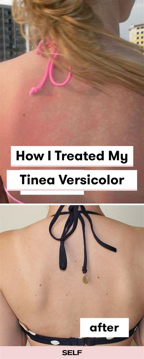 Tinea Versicolor Is Way More Common Than I Thought And Heres How I