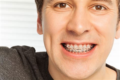 Clear Braces Pittman Orthodontics Orthodontist Martinsburg Wv