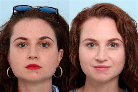 Botox Cosmetic Before And After Photo Gallery