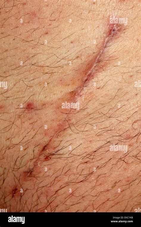 Hernia Surgery Scar Stock Photo Alamy
