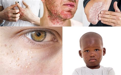 What Causes White Patches On Face Reequil
