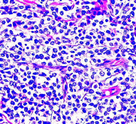 Subscriber sign in feedback select language share. Pathology Outlines - Leukemia cutis