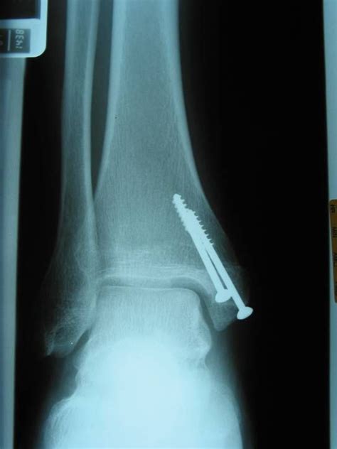 Broken Fibula Ankle Fracture Broken Fibula Broken Ankle