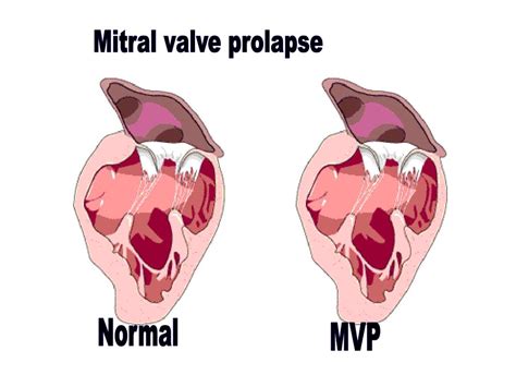 Mitral Valve Prolapse With Regurgitation