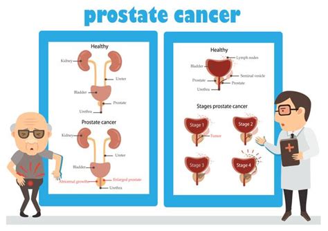 Having Several Sexual Partners Doubles Prostate Cancer Risk In Men Hindustan Times