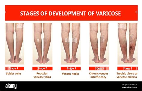 Varicose Veins On A Female Senior Legs The Stages Of Varicose Veins The Old Age And Sick Of A