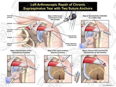 Left Arthroscopic Repair Of Chronic Supraspinatus Tear With Two Suture