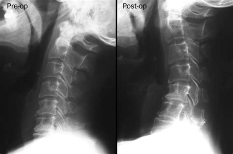 Lateral Plain Radiograph Of The Cervical Spine Showed The Complication